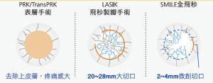 近視雷射手術smile雷射smile雷射價格