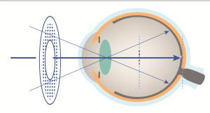 兒童近視控制角膜塑型片角膜塑型片價格