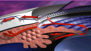 急性青光眼青光眼英文青光眼手術