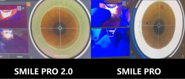 SMILE Pro恢復期SMILE Pro 2.0SMILE Pro 2.0價格