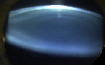 白內障白內障症狀自費人工水晶體費用一覽表