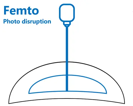 SMILE全飛秒smile pro缺點smile pro失敗