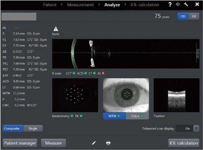 smilepro全飛秒近視雷射smile pro 2.0